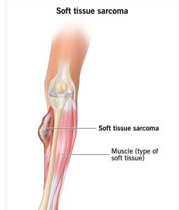 Soft tissue Sarcomas