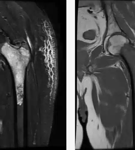 Malignant Bone Tumors