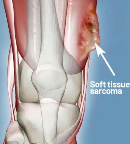Soft Tissue Sarcomas